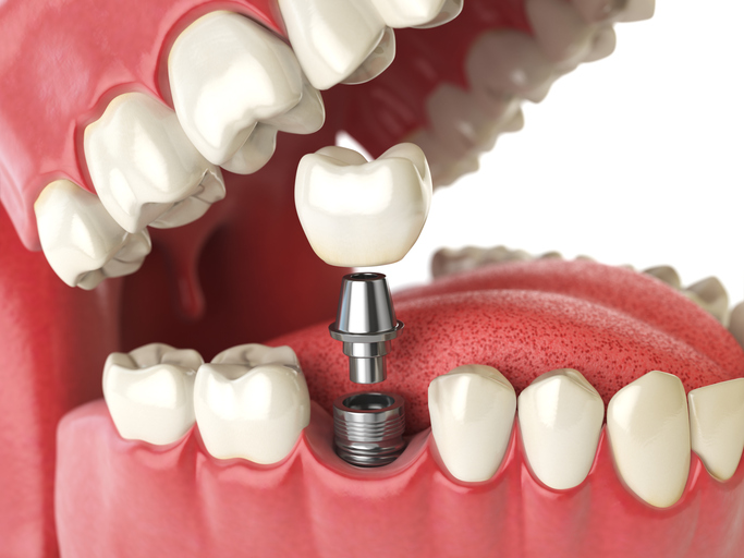 dental implants gresham or
